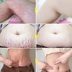 Stretch Marks Removal Cream