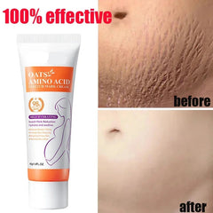 Stretch Marks Removal Cream